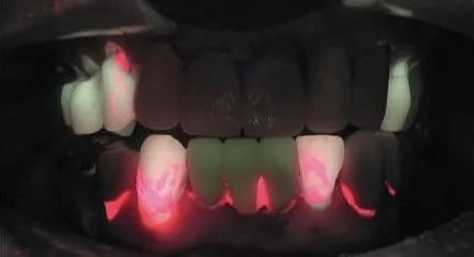 Fluorescência QLF evidenciando resíduo de resina no esmalte