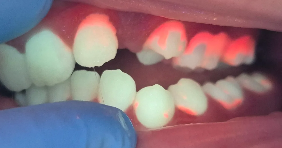 Uso do QScan Plus em consulta de periodontia